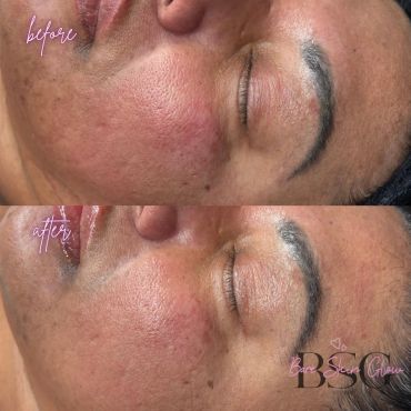 Before and after skin treatment showing reduced redness and smoother texture.