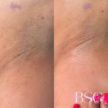 Comparison of underarm skin before and after treatment.