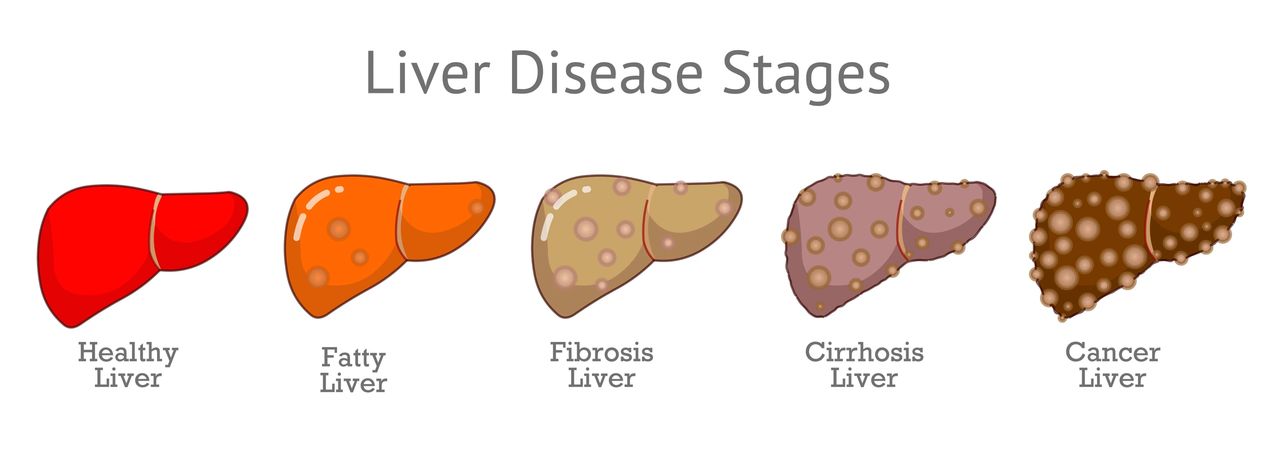 Fatty Liver Disease