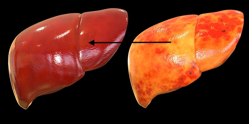 fatty liver and normal liver