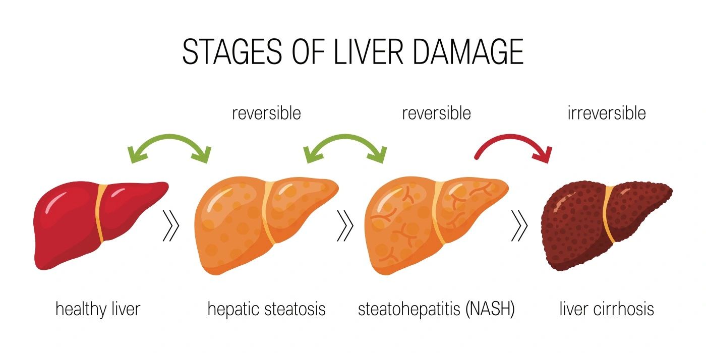 Fatty Liver Disease