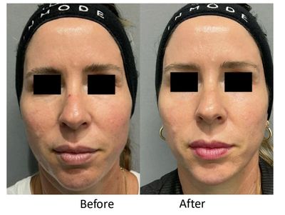 Shows dramatic improvements with 1 PicoFY® laser facial treatment at Glow & Contour Wellness MedSpa