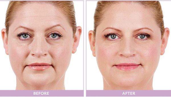 A woman showing changes to face with Juvederm Filler
