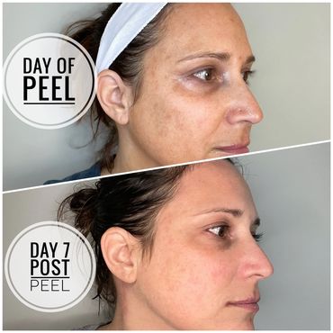 Side profile view of face to show changes from day 1 of VI peel to Day 7. 