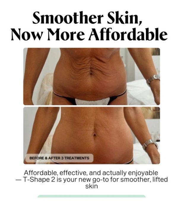 Before and after T-Shape 2 skin treatments showing smoother skin.