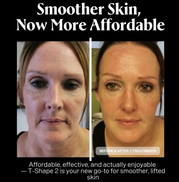 Before and after images show smoother skin after 3 T-Shape 2 treatments.