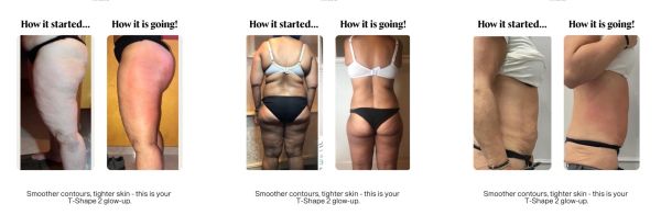 Comparison photos showing progress in smoother skin and tighter contours.