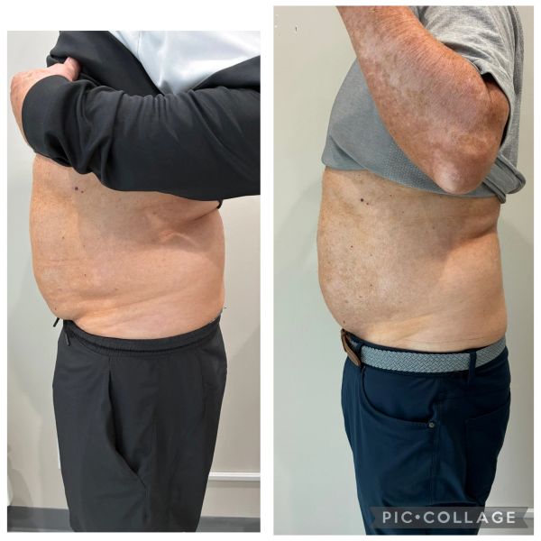Before and after photo of man's midsection showing weight loss.