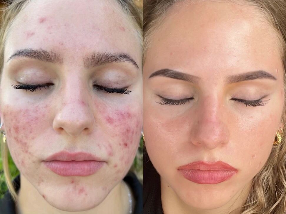 Beautiful results from Corium Corrective 360 product use only.  