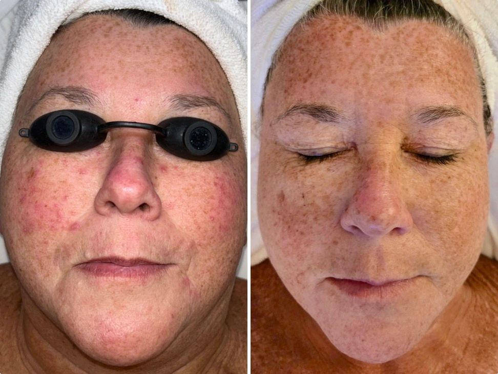 Rosacea homecare and education