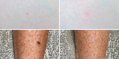 Thermoclear topical skin imperfection treatment