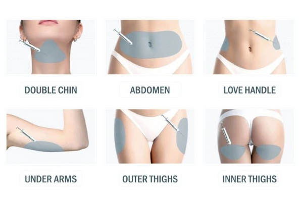 Illustration showing areas commonly treated with fat dissolving injections.
