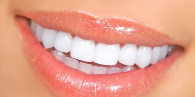 veneers