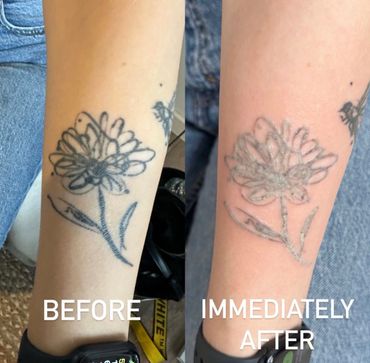 Laser tattoo removal