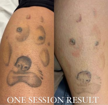 Laser tattoo removal