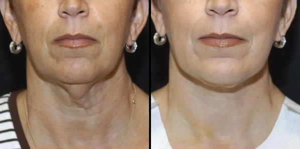 Skin Tightening Neck- IPL Treatment