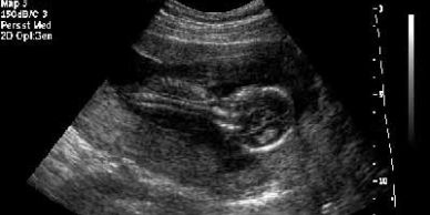 Ultrasound image of a fetus inside the womb.