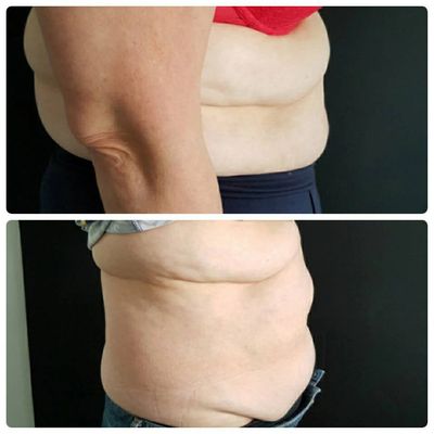 man’s belly before and after