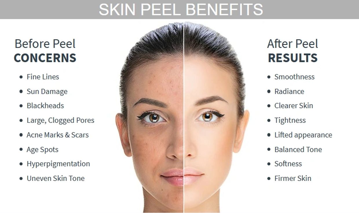 Chemical peel before and after image 