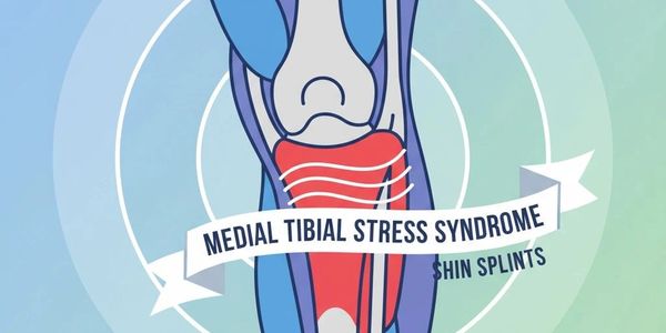 Illustration of medial tibial stress syndrome (shin splints).
