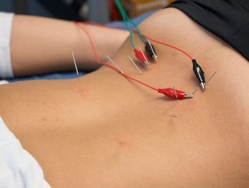 Dry Needling With Electrical Stimulation: A Pain Solution? - CityPT