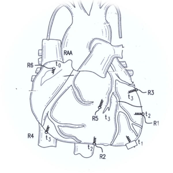 Illustration of epicardial pacing positions on the external surface of the heart