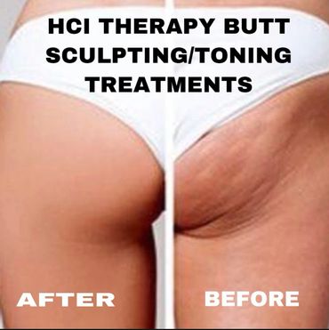 CryoToning Butt Sculpting