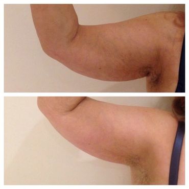 CrroToning of the arm fat