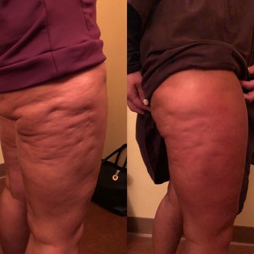 CryoSlimming Cellulite Removal