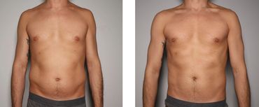 CryoSlimming of the Abdomen