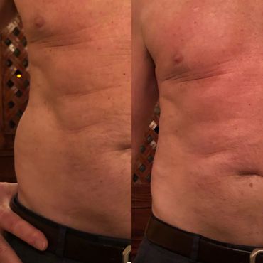 CryoSlimming love handle removal
