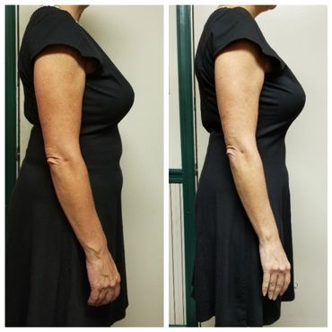 Results after CryoSlimming treatments