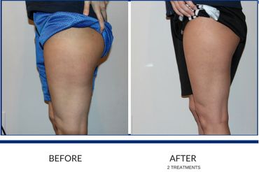 CryoSlimming on thighs, butt and legs