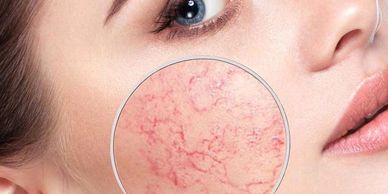couperose cheek capillaries