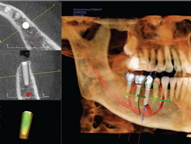 Cone Beam CT Scan (CBCT) is an imaging technique that provides 3-