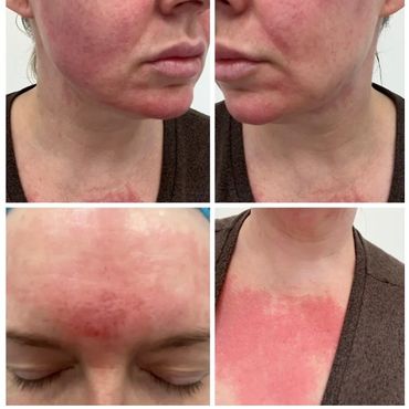 Close-up of facial and chest redness and irritation on a person.