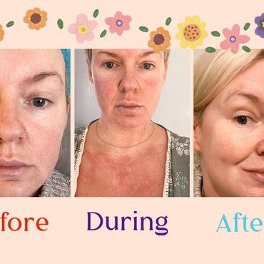 Woman's skin healing journey shown in before, during, and after photos with floral border.