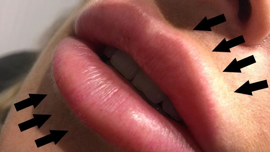 Why Can Lip Filler Migrate?