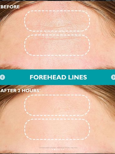 Before and after images showing reduced forehead lines after 2 hours.