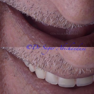 Full mouth dental implants in Mumbai planned by Dr Sagar Abichandani at The Dental Hub
