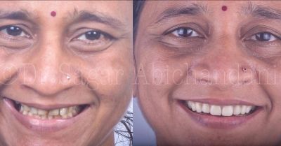 Full mouth rehabilitation planning in Mumbai by Dr Sagar Abichandani at The Dental Hub
