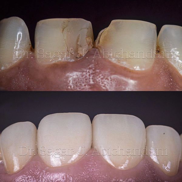 gaps between the teeth closed with ceramic veneers 