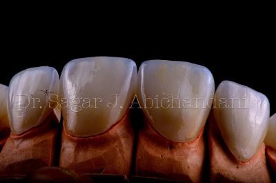 Dental veneers in Mumbai by Dr. Sagar J. Abichandani, MDS Prosthodontist, at The Dental Hub Chembur 