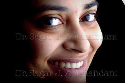 Invisalign and clear aligners in Mumbai by Dr. Sagar J. Abichandani at The Dental Hub Chembur and Lo