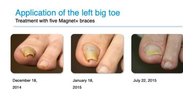 Progression of big toe treatment with magnets and braces over several months.