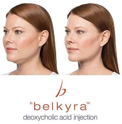 Belkyra®, Richmond Botox® Clinic, by Dr. Ward
