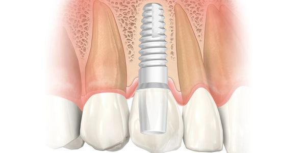 Metal Free, Ceramic Zirconia Dental Implant