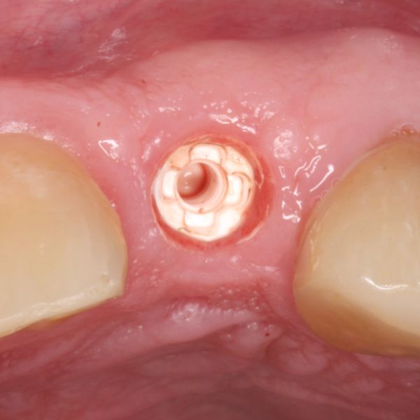 Metal Free, Ceramic Zirconia Dental Implant