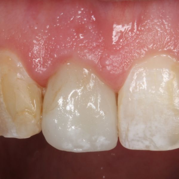 Metal Free, Ceramic Zirconia Dental Implant