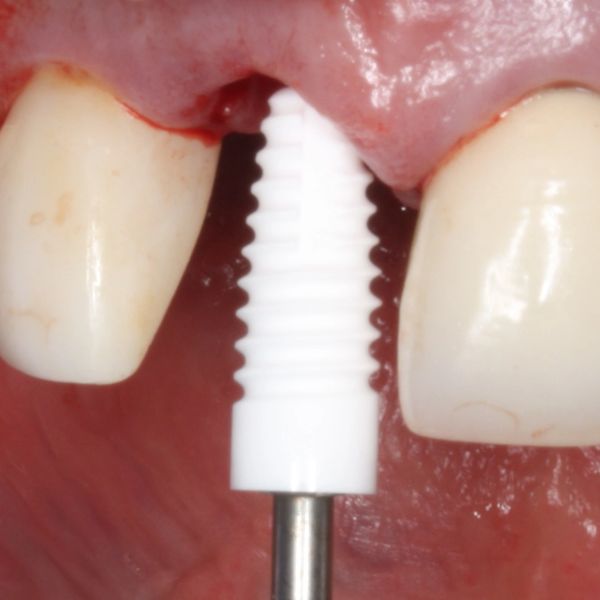 Metal Free, Ceramic Zirconia Dental Implant